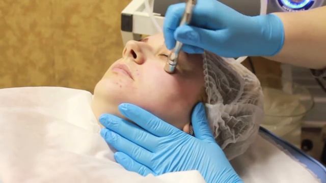 Дермабразия. Лучшие цены в Москве! смотреть онлайн