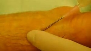 Лечение гигромы (пункция)