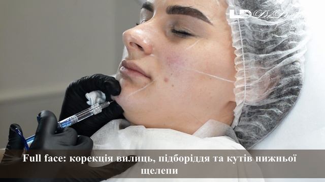 Контурная пластика лица Aliaxin - Контурна пластика обличчя Aliaxin