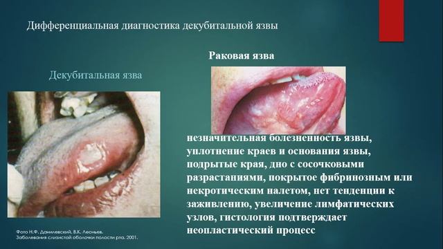 Лекция "Травматические поражения слизистой оболочки полости рта" смотреть онлайн