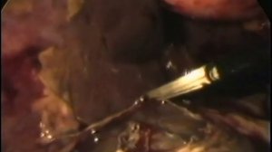 Лапароскопическое дренирование при остром панкреатите