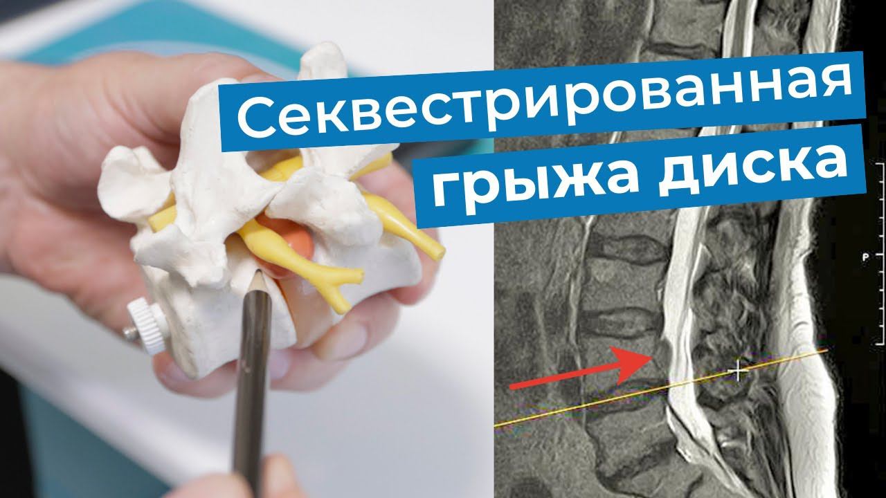 Лечение секвестрированной грыжи диска позвоночника