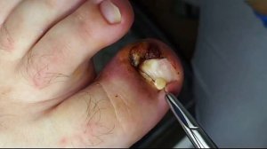 ГИПЕРГРАНУЛЯЦИЯ??⚠️ • Установка коррекционной системы??• ЧАСТЬ 2