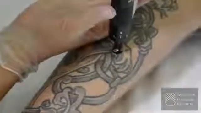 Удаление татуировки лазером смотреть онлайн