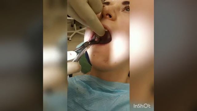 Удаление восьмёрки (зуба мудрости ) все этапы ) смотреть онлайн