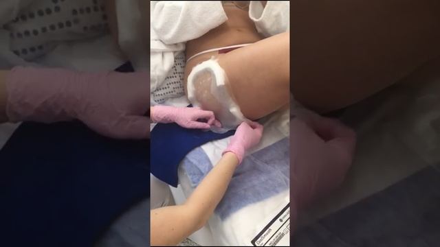 Липосакция без хирургии зоны галифе
