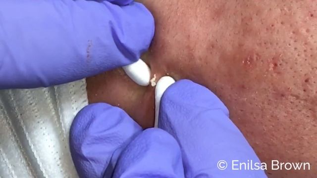 Blackheads, Whiteheads Extractions on "K" Part 1 смотреть онлайн
