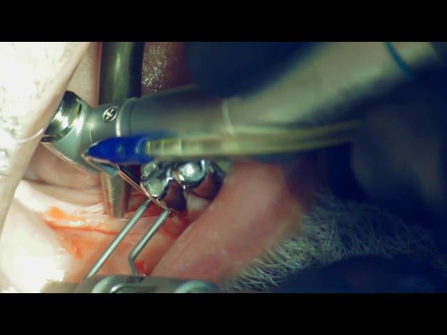 Orthodontic caliper in implantology