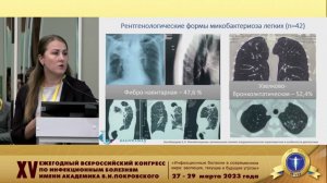 Микобактериозы у лиц с различным ВИЧ-статусом