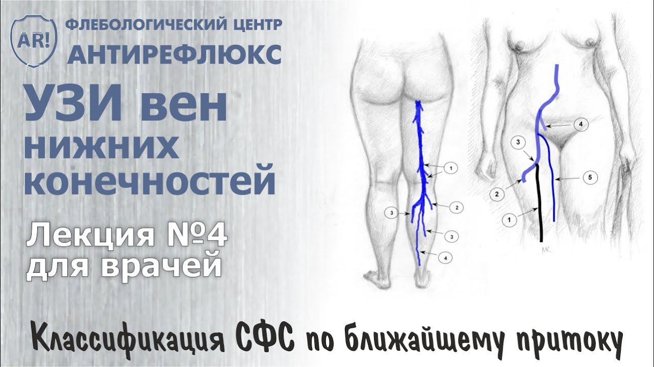 УЗИ вен. Классификация СФС по ближайшему притоку