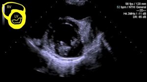 Transthoracic echo (TTE) for beginners