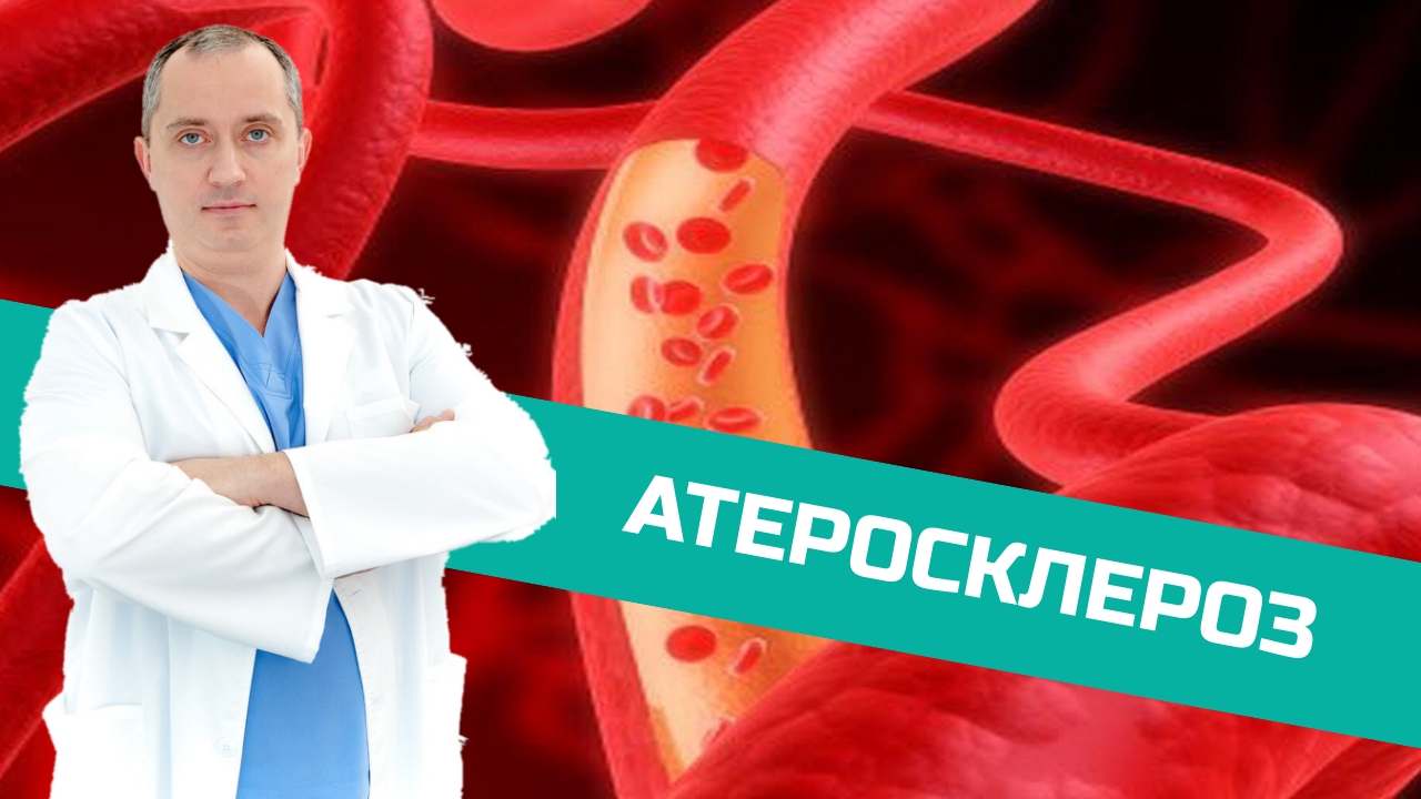 Атеросклеротические бляшки – можно ли их убрать