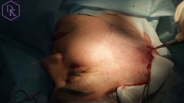 Гульмира Бахыткызы делает подтяжку лица смотреть онлайн