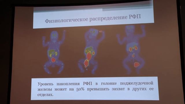 Рыжкова Д.В. - ПЭТ с [18F]-ДОФА в диагностике врожденного гиперинсулинизма смотреть онлайн
