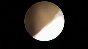 Дефект миометрия после фокусной ультразвуковой аблации по поводу миомы матки