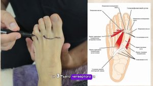 вальгус(косточка "шишка" на стопе)