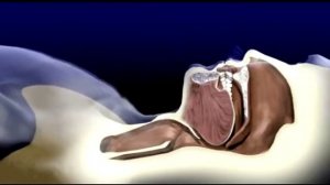 Как избавиться от храпа?