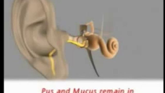 Острый катаральный средний отит.mp4 смотреть онлайн