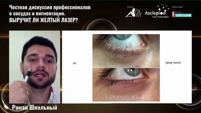 Альфа СПА. Честная дискуссия профессионалов о сосудах и пигментации. Выручит ли желтый лазер? смотреть онлайн