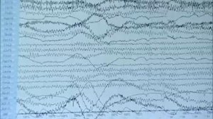 Электроэнцефалография.