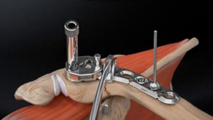 Лечение перелома дистального отдела ключицы с помощью фиксации клювовидного отростка.