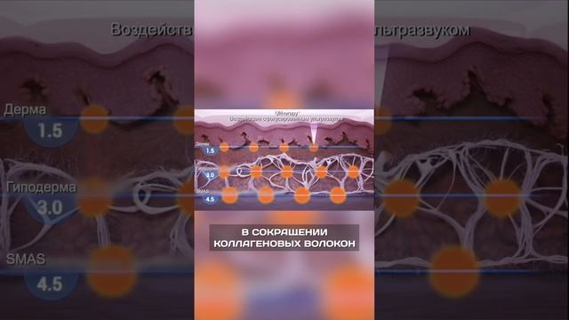 SMAS-ЛИФТИНГ УЛЬТРАФОРМЕР. КАК ЭТО РАБОТАЕТ? #косметология #лифтинг #ультраформер #омоложение