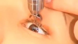 Давящая боль в области глаз. Внутриглазное давление.