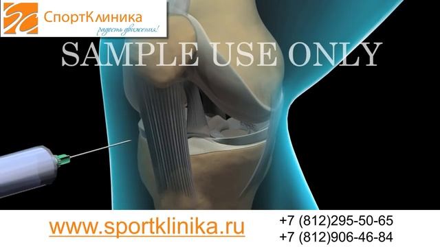 Артроскопия. Повреждение медиального мениска мениск