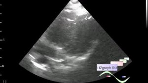 Детское УЗИ сердца (эхокардиография) - Состояние после радикальной коррекции ВПС