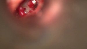 установка и фиксация протеза при стапедопластике