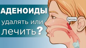 АДЕНОИДЫ у детей. Степени, осложнения и лечение