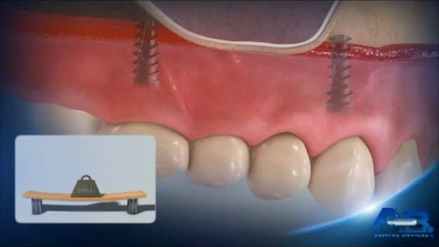 6.2. Короткие имплантаты: Верхняя челюсть смотреть онлайн