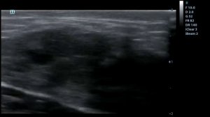 Карцинома молочной железы