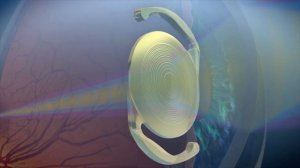 ИОЛ нового поколения AcrySof IQ PanOptix