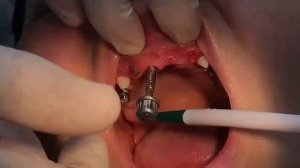 Placement 2 GMI into maxilla Monolyth