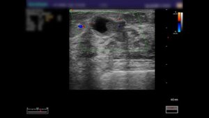 Внутрипротоковая папиллома молочной железы (УЗИ)