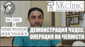 Челюстно-лицевой хирург Назарян Д.Н. Удаление опухоли верхней челюсти с замещением трансплантатом.