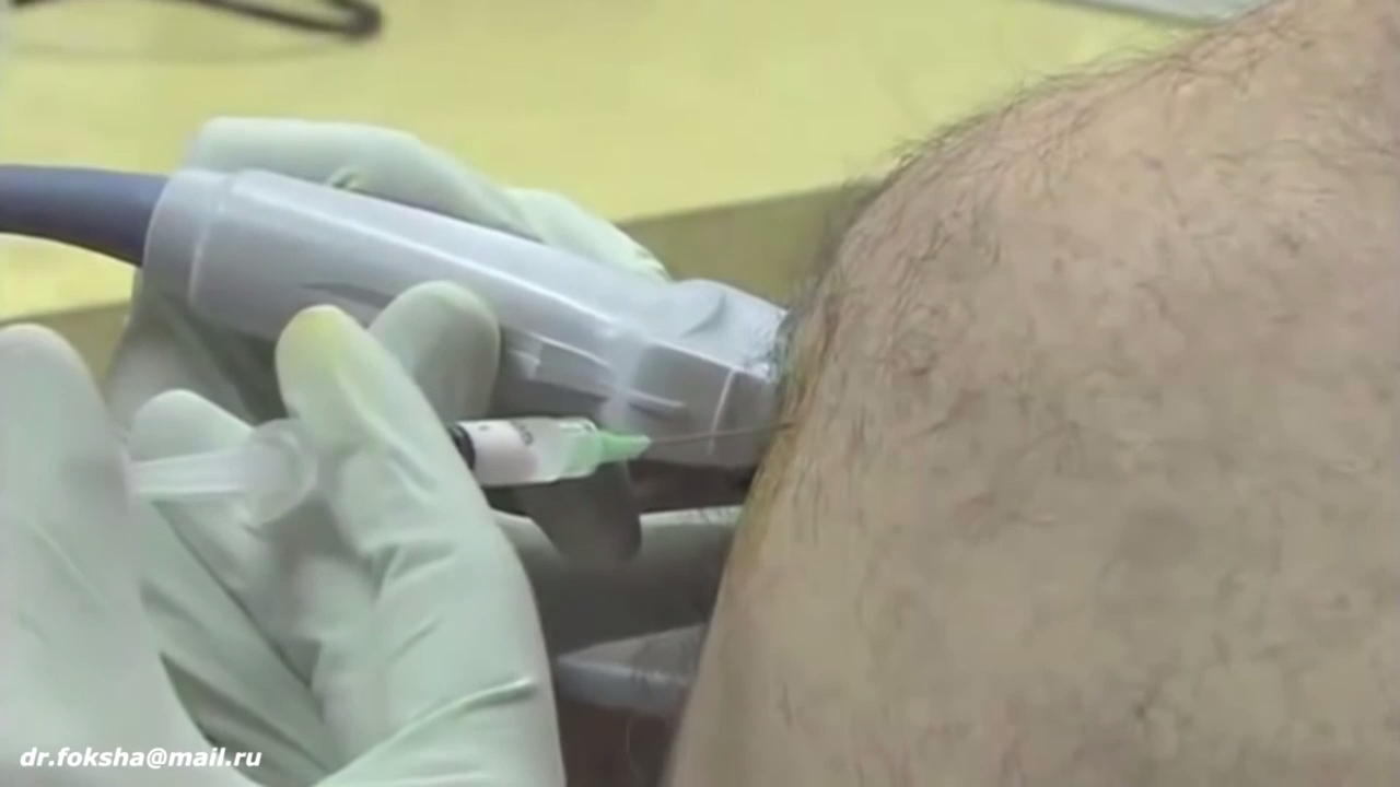 Блокада УЗИ контроль Боль в плече Ultrasound Guided Shoulder Injection