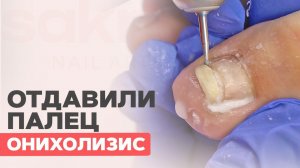 Онихолизис и травма, что делать  Поможет ли зачистка ?