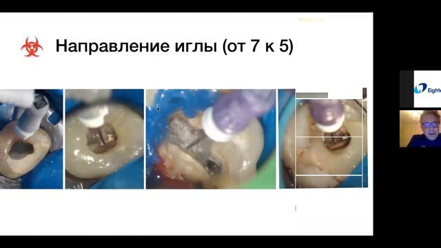 Вебинар на русском-Болячин Алексей-Тема:Особенности препарирования длинных и искривленных каналов смотреть онлайн