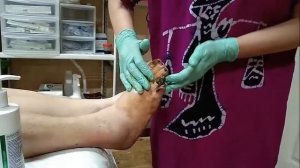 Обработка Виватоном диабетической стопы.mp4