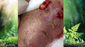 How To Removal Blackheads And How To Get Rid Of Blackhead On Face