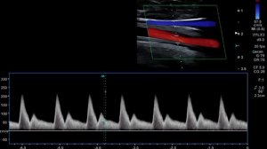 Неспецифический аортоартериит.