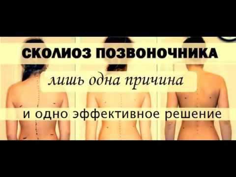 Сколиоз у детей, у подростков, у взрослых. Как лечить искривление позвоночника.