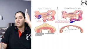 IBD | Ulcerative colitis (UC) and Crohn's Disease – What Are The Differences? MedLive by Dr Priyank