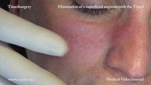 25 Treatment of a superficial  skin angioma of the face with  Electroporo Cosmesis TRAILER