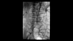 Реканализация и стентирование аорты при синдроме Лериша
