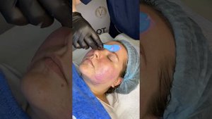 Миндальный пилинг