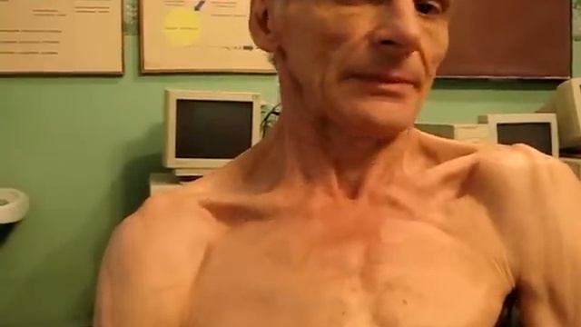 Гиперкинез при хореи Гентингтона смотреть онлайн