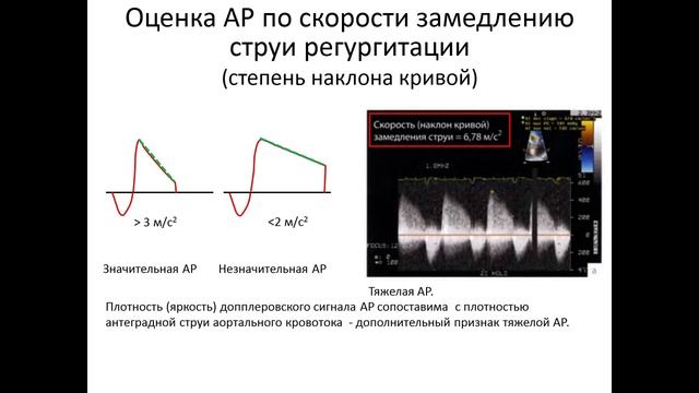Митральная регургитация 2 степени на узи. Регургитация клапана. Трикуспидальная регургитация 1. Струя регургитации. Струя регургитации.